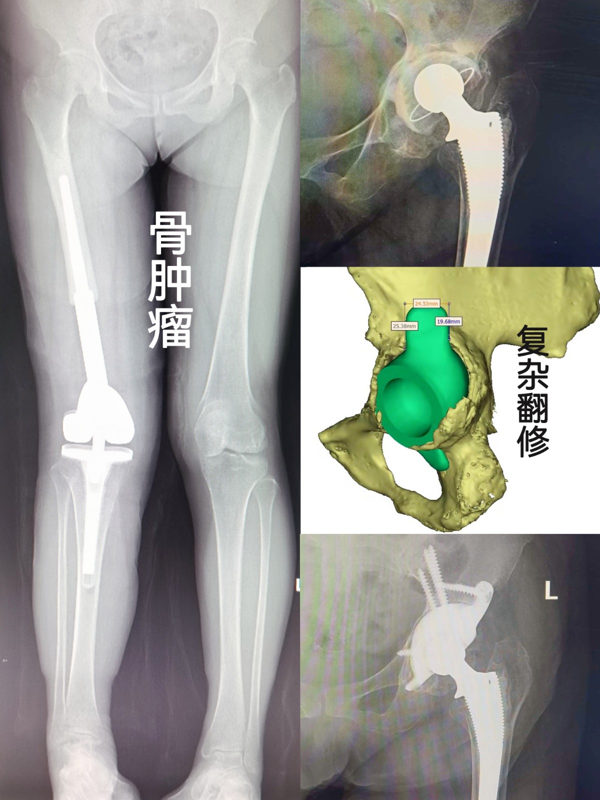 复杂髋翻修.jpg